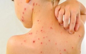 Varicella Sintomi Varicella Sintomi
